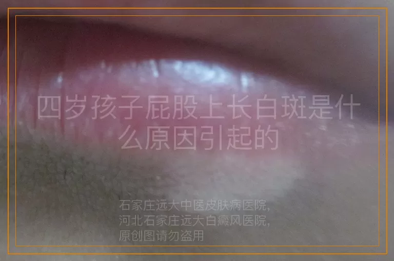 四岁孩子屁股上长白斑是什么原因引起的