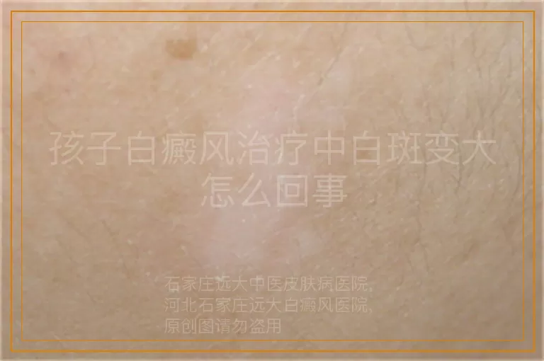 孩子白癜风治疗中白斑变大怎么回事