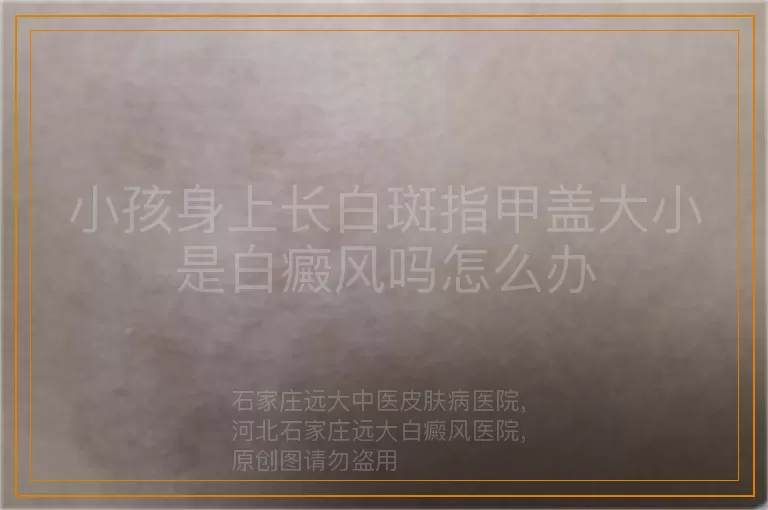 小孩身上长白斑指甲盖大小是白癜风吗怎么办