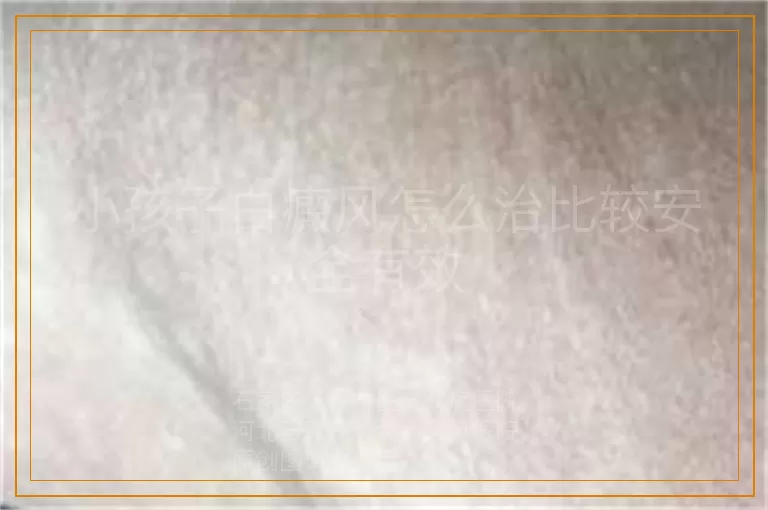 小孩子白癜风怎么治比较安全有效
