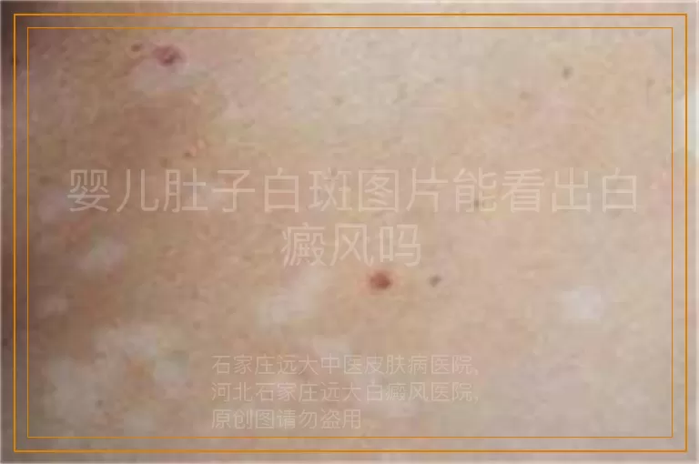 婴儿肚子白斑图片能看出白癜风吗