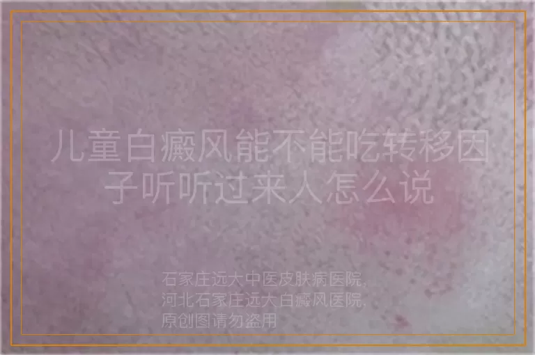 儿童白癜风能不能吃转移因子听听过来人怎么说