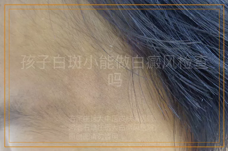 孩子白斑小能做白癜风检查吗