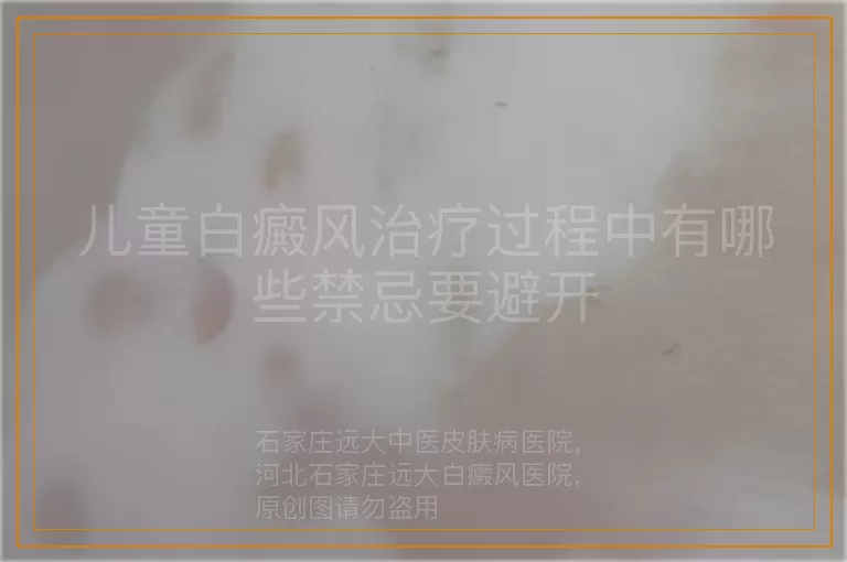 儿童白癜风治疗过程中有哪些禁忌要避开