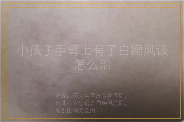 小孩子手臂上有了白癜风该怎么治