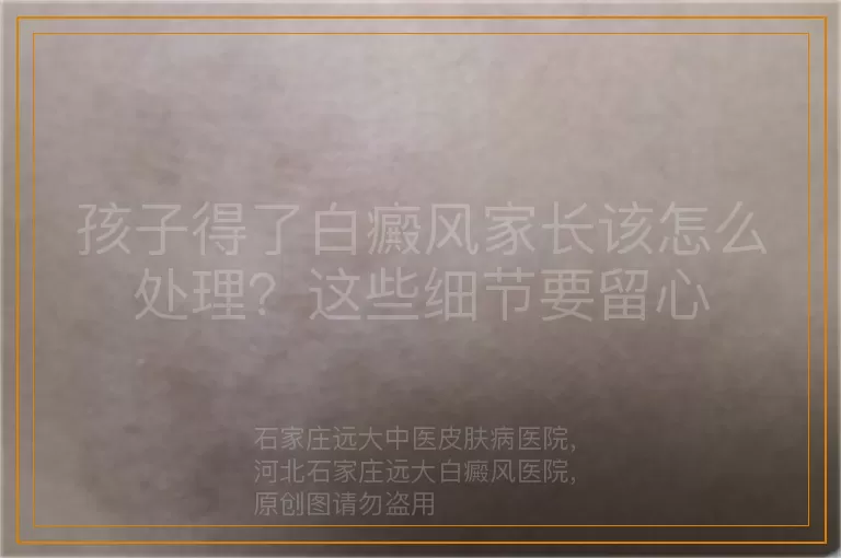 孩子得了白癜风家长该怎么处理？这些细节要留心