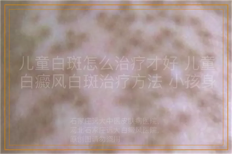 儿童白斑怎么治疗才好 儿童白癜风白斑治疗方法 小孩身上白斑如何应对