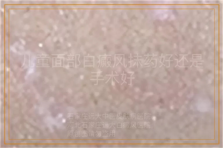 儿童面部白癜风抹药好还是手术好
