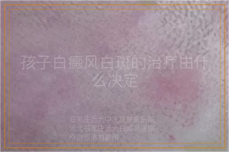 孩子白癜风白斑的治疗由什么决定