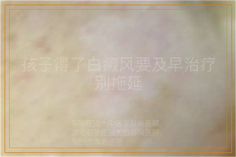孩子得了白癜风要及早治疗别拖延