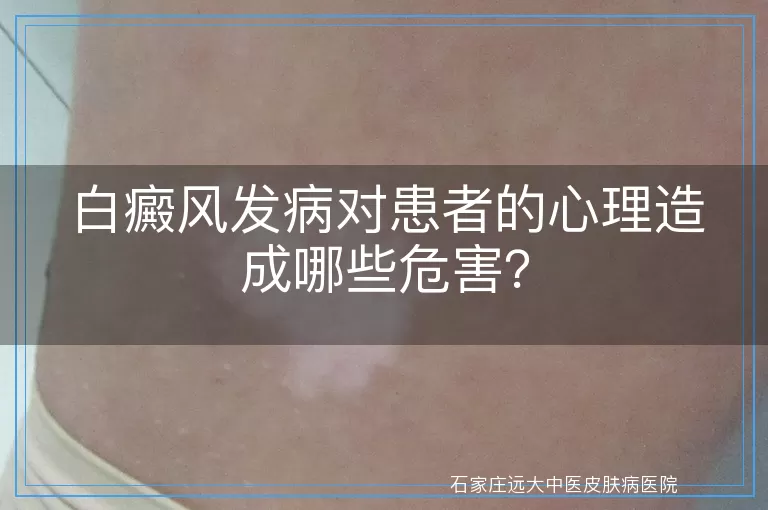 白癜风发病对患者的心理造成哪些危害？