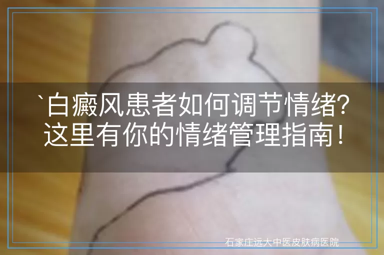 白癜风患者如何调节情绪？这里有你的情绪管理指南！