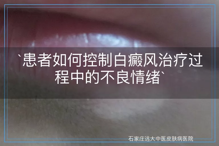 患者如何控制白癜风治疗过程中的不良情绪