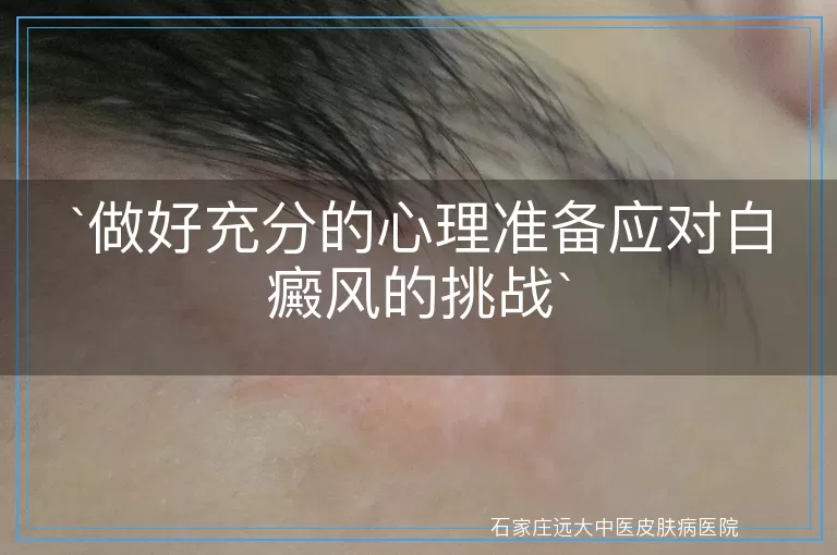 做好充分的心理准备应对白癜风的挑战