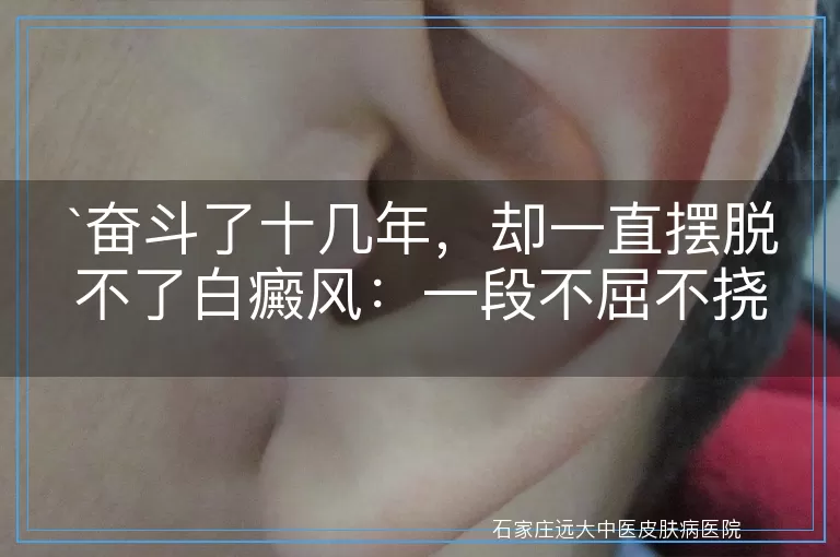 奋斗了十几年，却一直摆脱不了白癜风：一段不屈不挠的抗争历程