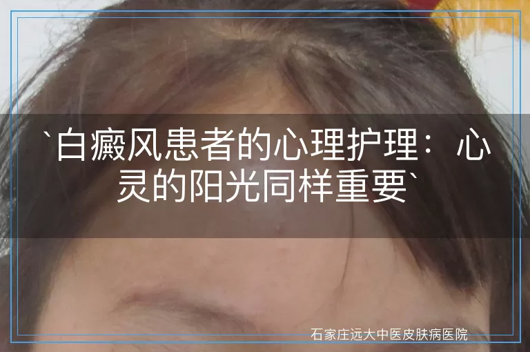 白癜风患者的心理护理：心灵的阳光同样重要