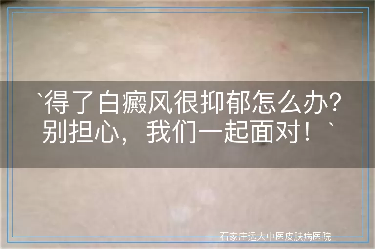 得了白癜风很抑郁怎么办？别担心，我们一起面对！
