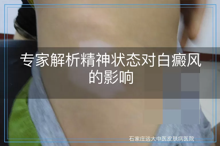 专家解析精神状态对白癜风的影响