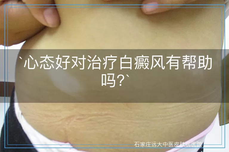 心态好对治疗白癜风有帮助吗?