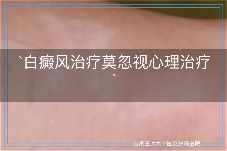 白癜风治疗莫忽视心理治疗