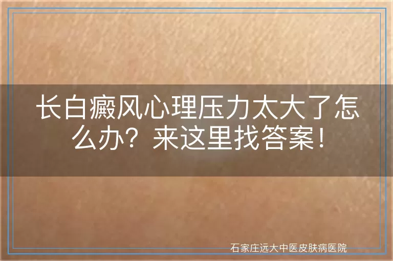 长白癜风心理压力太大了怎么办？来这里找答案！