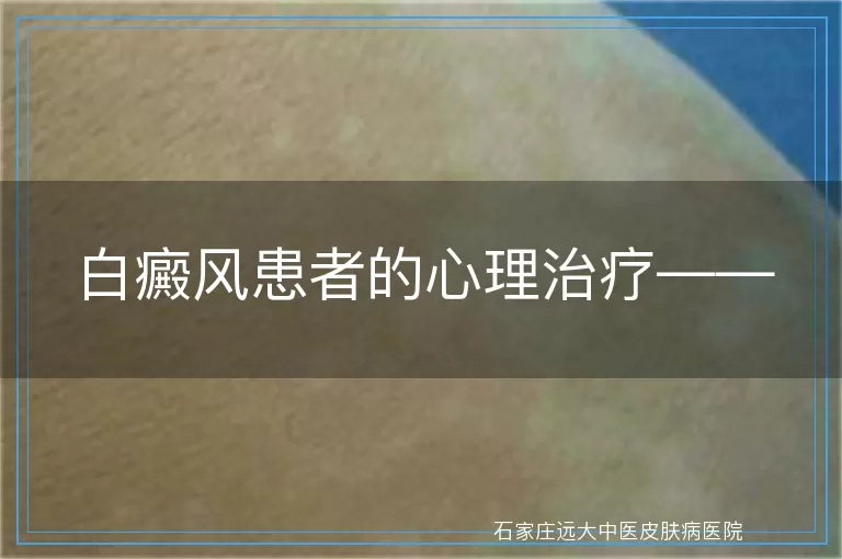 白癜风患者的心理治疗——