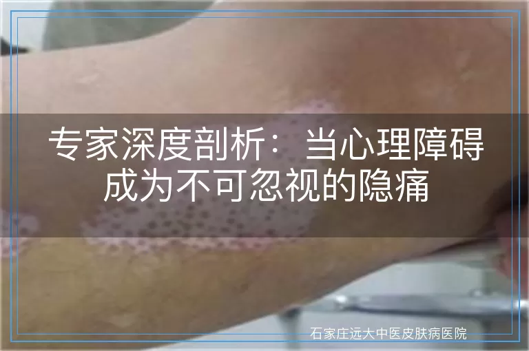 专家深度剖析：当心理障碍成为不可忽视的隐痛