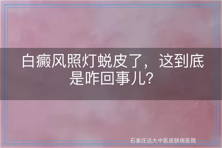 白癜风照灯蜕皮了，这到底是咋回事儿？