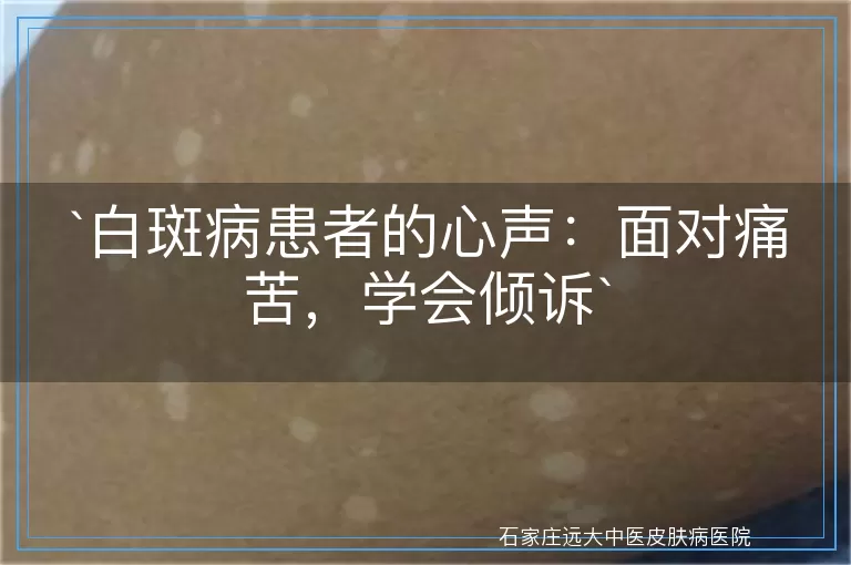 白斑病患者的心声：面对痛苦，学会倾诉