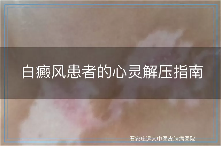 白癜风患者的心灵解压指南