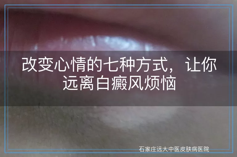 改变心情的七种方式，让你远离白癜风烦恼