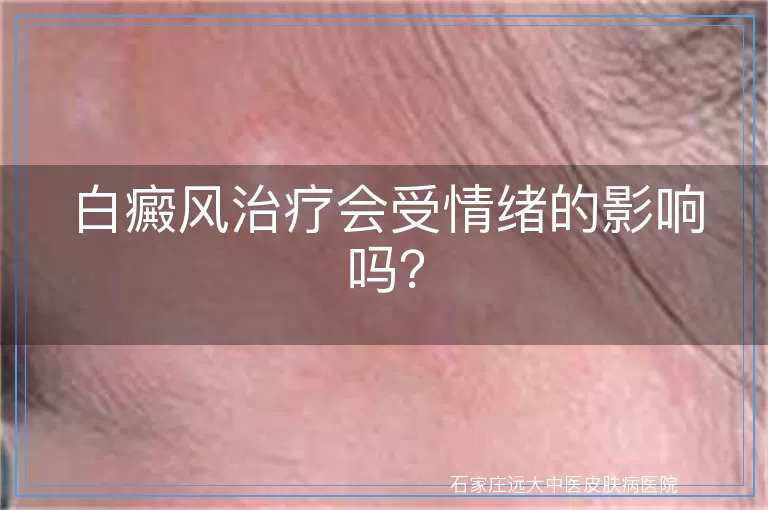 白癜风治疗会受情绪的影响吗？