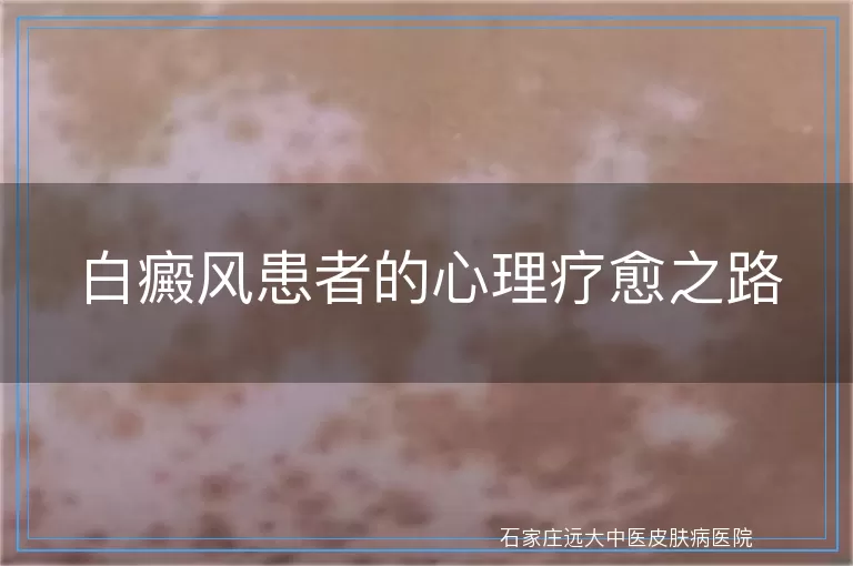 白癜风患者的心理疗愈之路