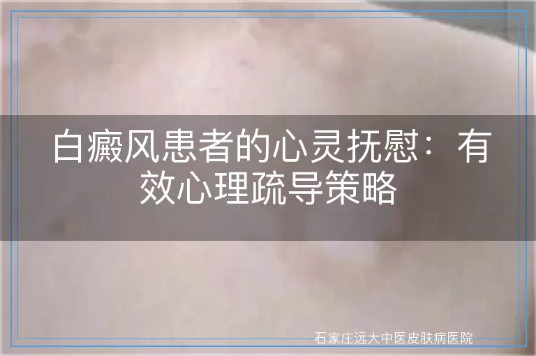 白癜风患者的心灵抚慰：有效心理疏导策略