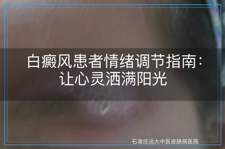 白癜风患者情绪调节指南：让心灵洒满阳光