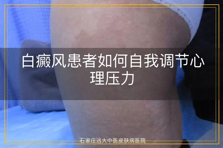 白癜风患者如何自我调节心理压力
