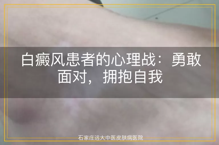 白癜风患者的心理战：勇敢面对，拥抱自我
