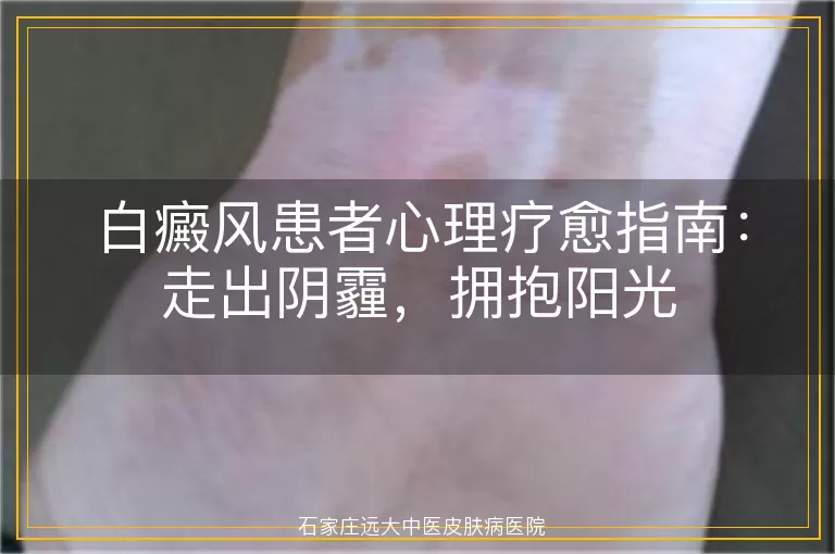 白癜风患者心理疗愈指南：走出阴霾，拥抱阳光