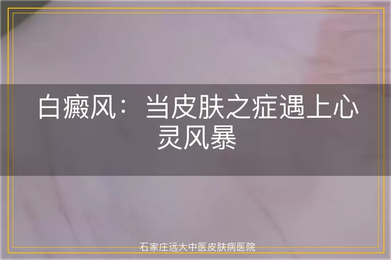白癜风：当皮肤之症遇上心灵风暴