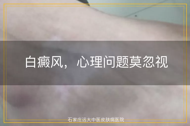 白癜风，心理问题莫忽视