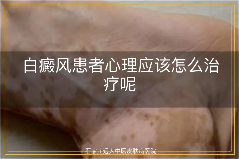 白癜风患者心理应该怎么治疗呢