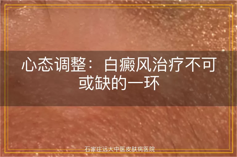 心态调整：白癜风治疗不可或缺的一环