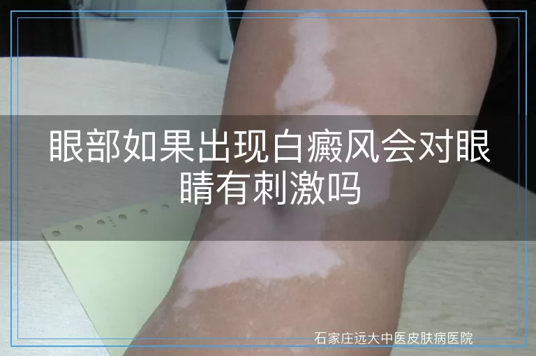 眼部如果出现白癜风会对眼睛有刺激吗
