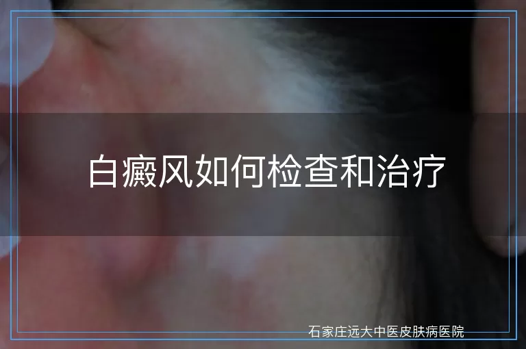 白癜风如何检查和治疗