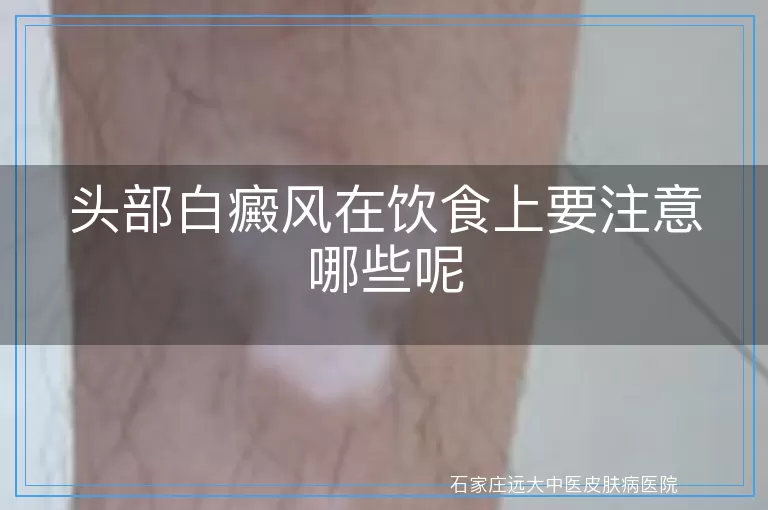 头部白癜风在饮食上要注意哪些呢