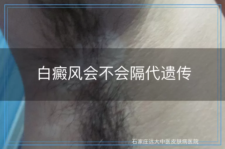 白癜风会不会隔代遗传