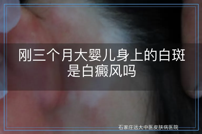 刚三个月大婴儿身上的白斑是白癜风吗