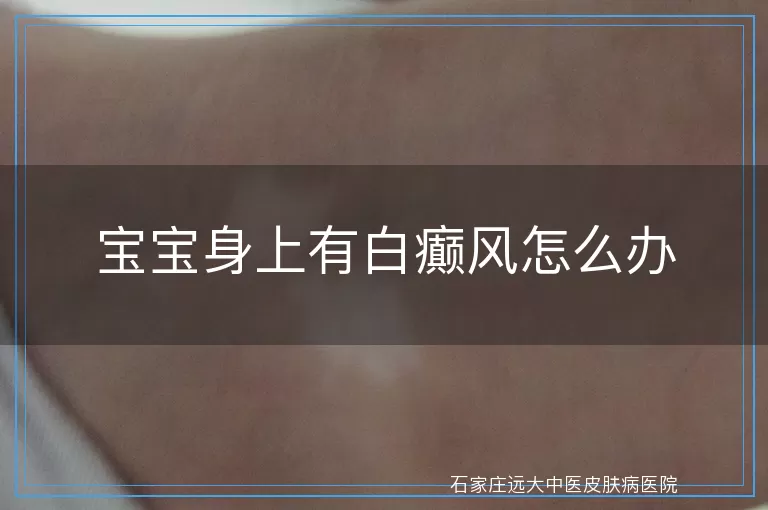 宝宝身上有白癫风怎么办