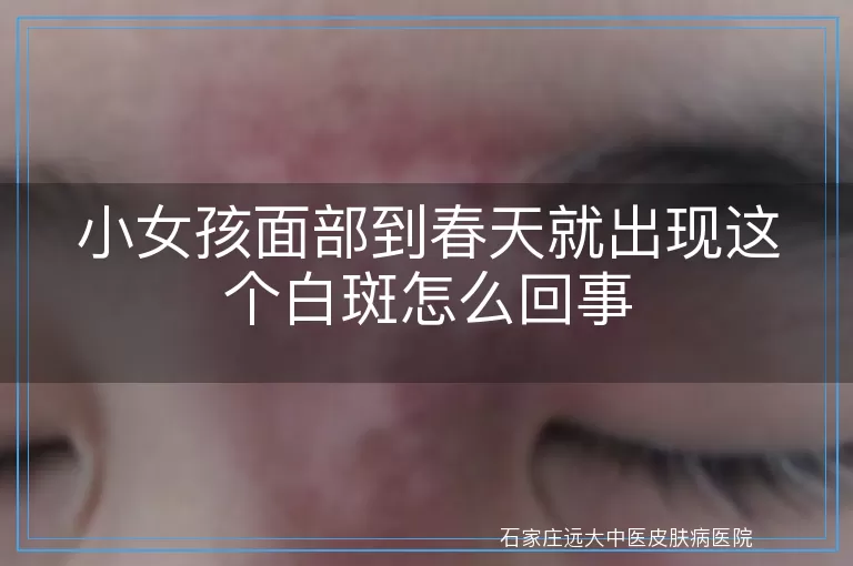 小女孩面部到春天就出现这个白斑怎么回事