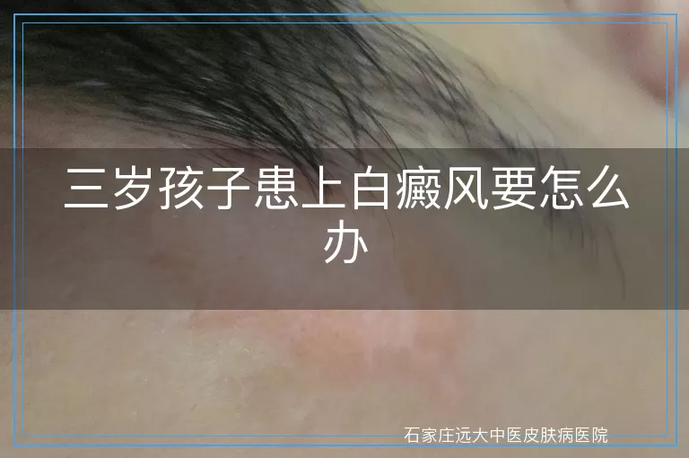 三岁孩子患上白癜风要怎么办